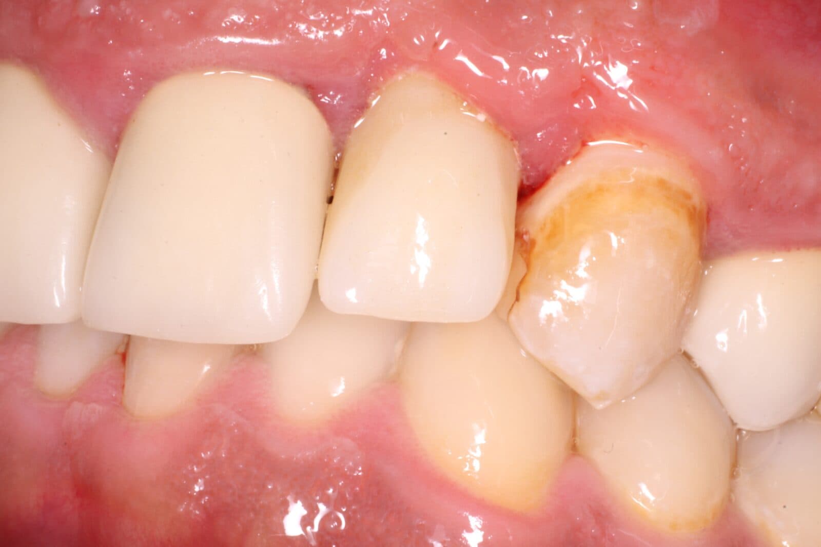 Implantatkrone am Tag der Eingliederung