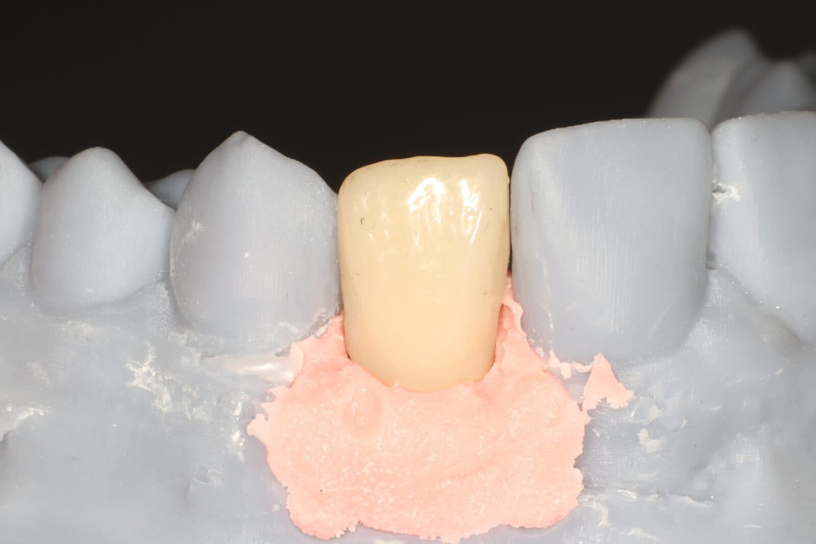 Fertige Implantatkrone auf dem Meistermodell