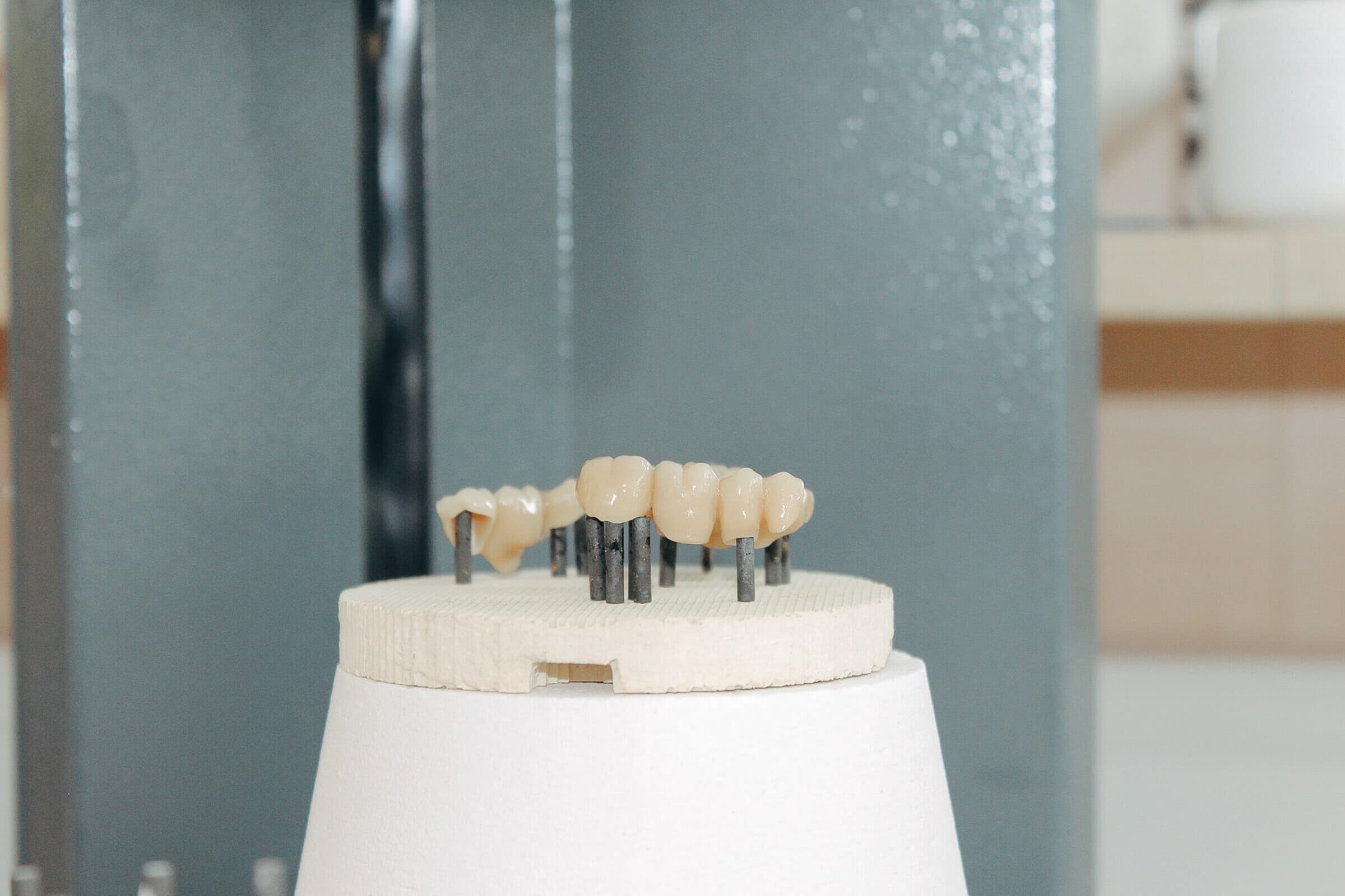Inlay und Onlay — Präzision aus dem Dentallabor